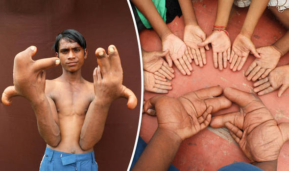 Découverte captivante: la maladie rare d’un garçon indien provoque la confusion avec un bras long de 12 pouces