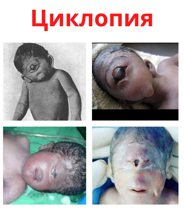 “Terrible descubrimiento: Caos global desatado por un mutante recién nacido con característicɑs monstruosas y un solo ojo”